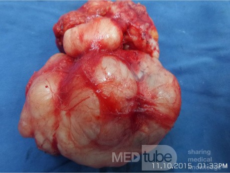 Breast Giant Fibroadenoma