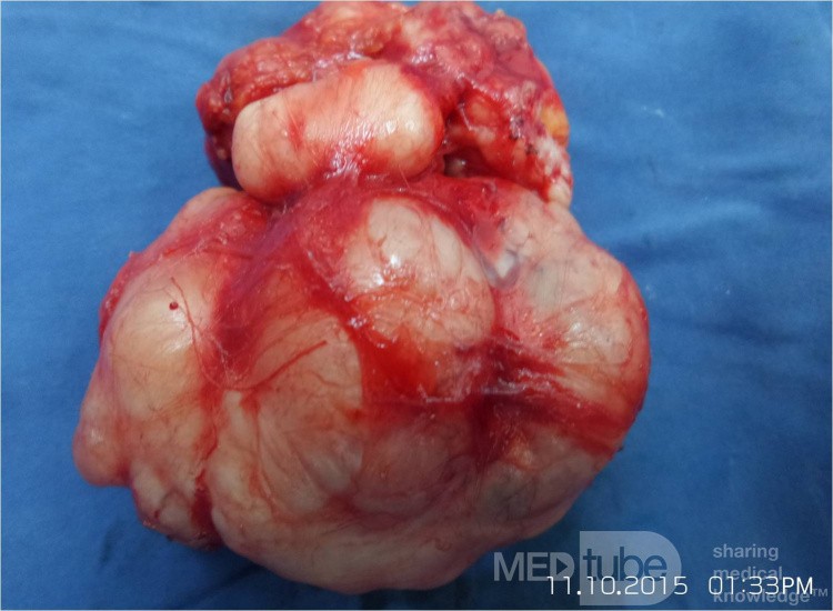 Breast Giant Fibroadenoma