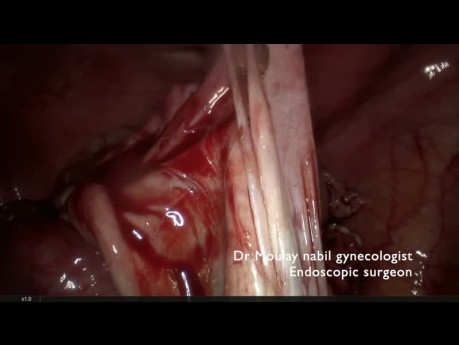 Emergency Laparoscopy for Left Adnexal Torsion