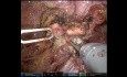 Robotic Sigmoidectomy & Rectopexy