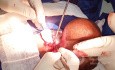 Meningocele in an 18-year-old patient