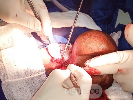 Meningocele in an 18-year-old patient