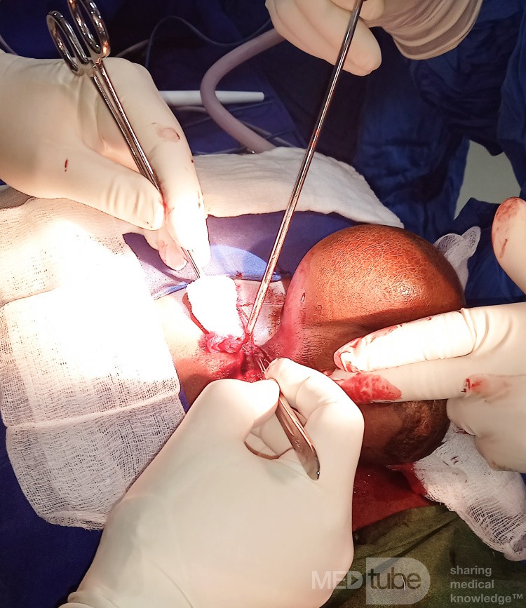 Meningocele in an 18-year-old patient