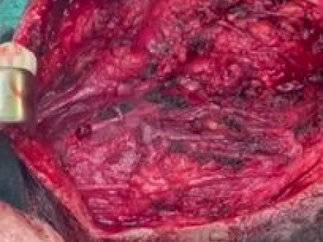 Parotidectomy
