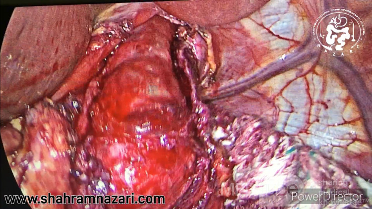 Myotomy for Achalasia