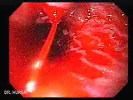 Esophageal Varix - Endoscopic View of Spurting Esophageal Varix