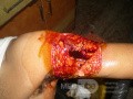 Blunt Injury Of The Arm