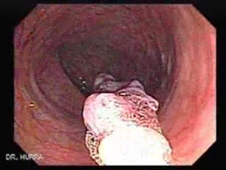 Huge Mass Of The Descending Colon (21 of 25)