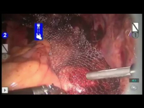 Robot Assisted Sacrocervicopexy with Bidirectional Quill® Barbed Suture