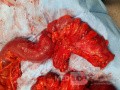 Subtotal Colectomy due to Rectosigmoid Obstruction