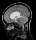 Endoscopic Third Ventriculostomy in a Benign Case of Aicardi Syndrome with Obstructive Hydrocephalus and Chiari Malformation type 1