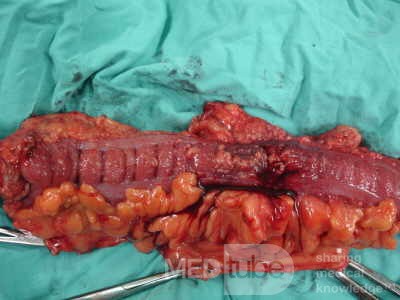 Adenocarcinoma of the Transverse Colon (13 of 15)