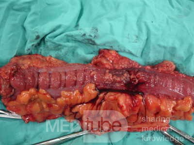 Adenocarcinoma of the Transverse Colon (13 of 15)