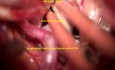 Complex Internal Carotid Artery Aneurysm-exoscopic-microsurgical Clipping/obliteration