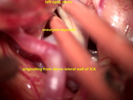 Complex Internal Carotid Artery Aneurysm-exoscopic-microsurgical Clipping/obliteration