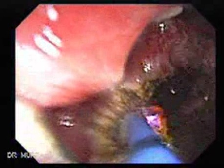 Multiple Adenomatous Polyps Of The Rectum (23 of 37)