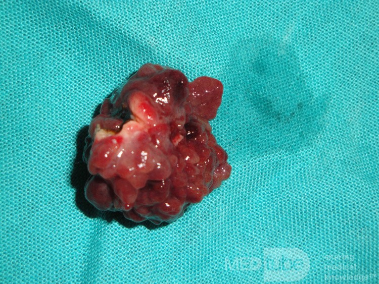 Giant Multilobulated Gastric Polyp (16 of 20)