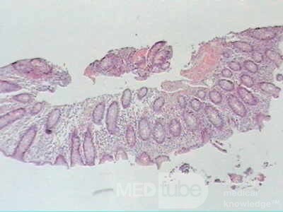 Trichuris Trichuris (whipworm) (17 of 19)