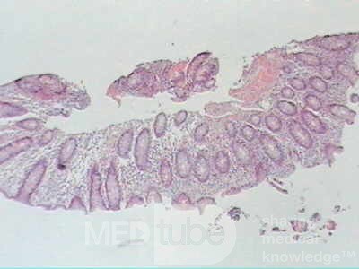 Trichuris Trichuris (whipworm) (17 of 19)
