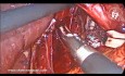 Laparoscopic Repair of Sliding Hiatal Hernia