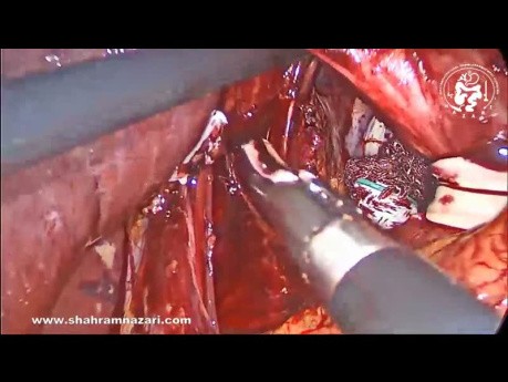Laparoscopic Repair of Sliding Hiatal Hernia