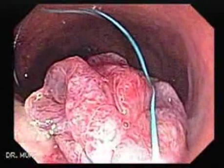 Huge Mass Of The Descending Colon (7 of 25)