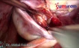 Bilateral Chocolate Cyst with Rectovaginal Nodules