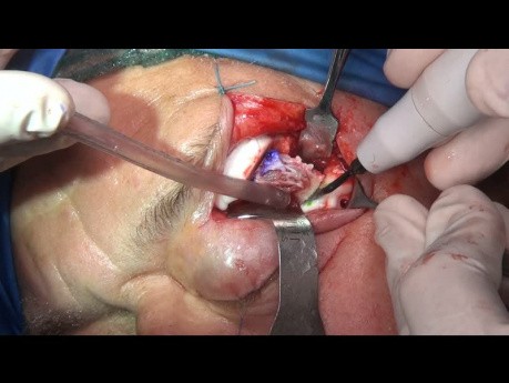 Primary Reconstruction with PEEK Implant of an Intraosseous Venous Malformation of the Lateral Orbital Rim