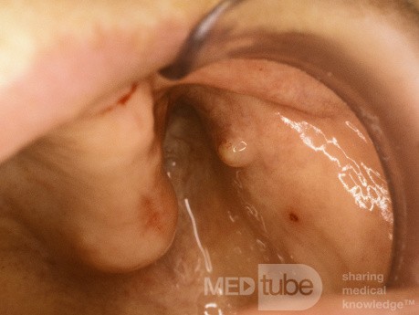 Stenson's Duct Orifice [left]