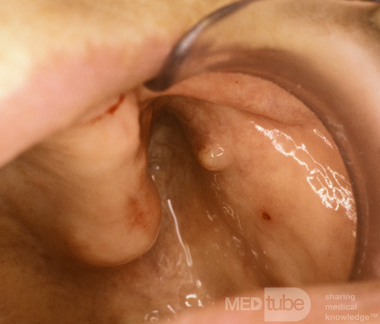 Stenson's Duct Orifice [left]