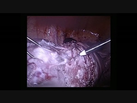 Water Jet Assisted Laparoscopic Myomectomy