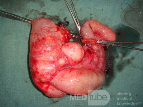 Intussusception, non Hodgkin's lymphoma - right hemicolectomy