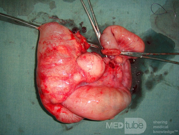 Intussusception, non Hodgkin's lymphoma - right hemicolectomy