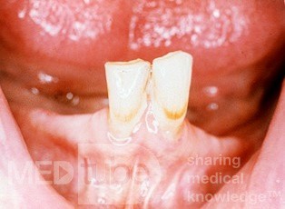 Mandibular Resorption