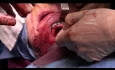 Atrophic Mandible Double Fracture