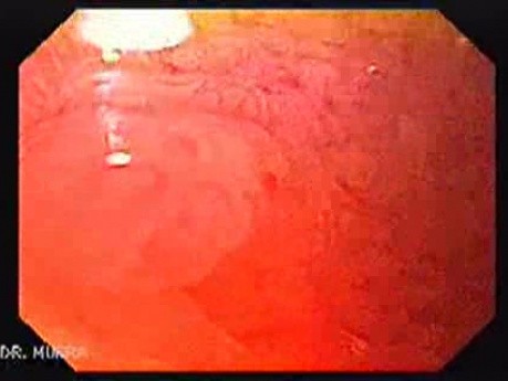 Brunner's Gland Hyperplasia (3 of 3)