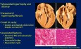 Echocardiographic Evaluation of Hypertrophic Cardiomyopathy (HCM)