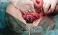 Ischemic Colitis