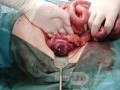 Ischemic Colitis