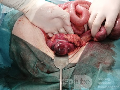 Ischemic Colitis