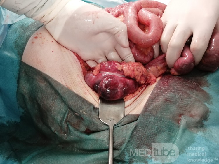 Ischemic Colitis