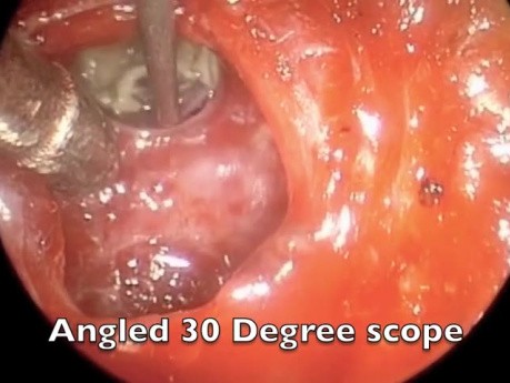 Endoscopic Pituitary Surgery - Potential Use of Angled Endoscope