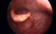 Thickened posterior commisure with limited left vocal fold mobility upon phonation