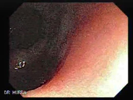 Colonic Lipoma (1 of 3)