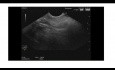 Endoscopic Ultraosound of Papillary Stenosis
