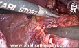 Laparoscopic Cholecystectomy /Accessory Right Hepatic Artery