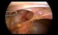 TAPP Medical History of Diverticulitis