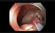 Colonoscopy - LST NG Tumor - Difficult Resection