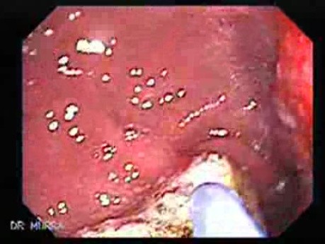 Multiple Adenomatous Polyps Of The Rectum (10 of 37)