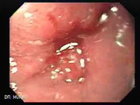 Adenocarcinoma of the middle third (2 of 5 )